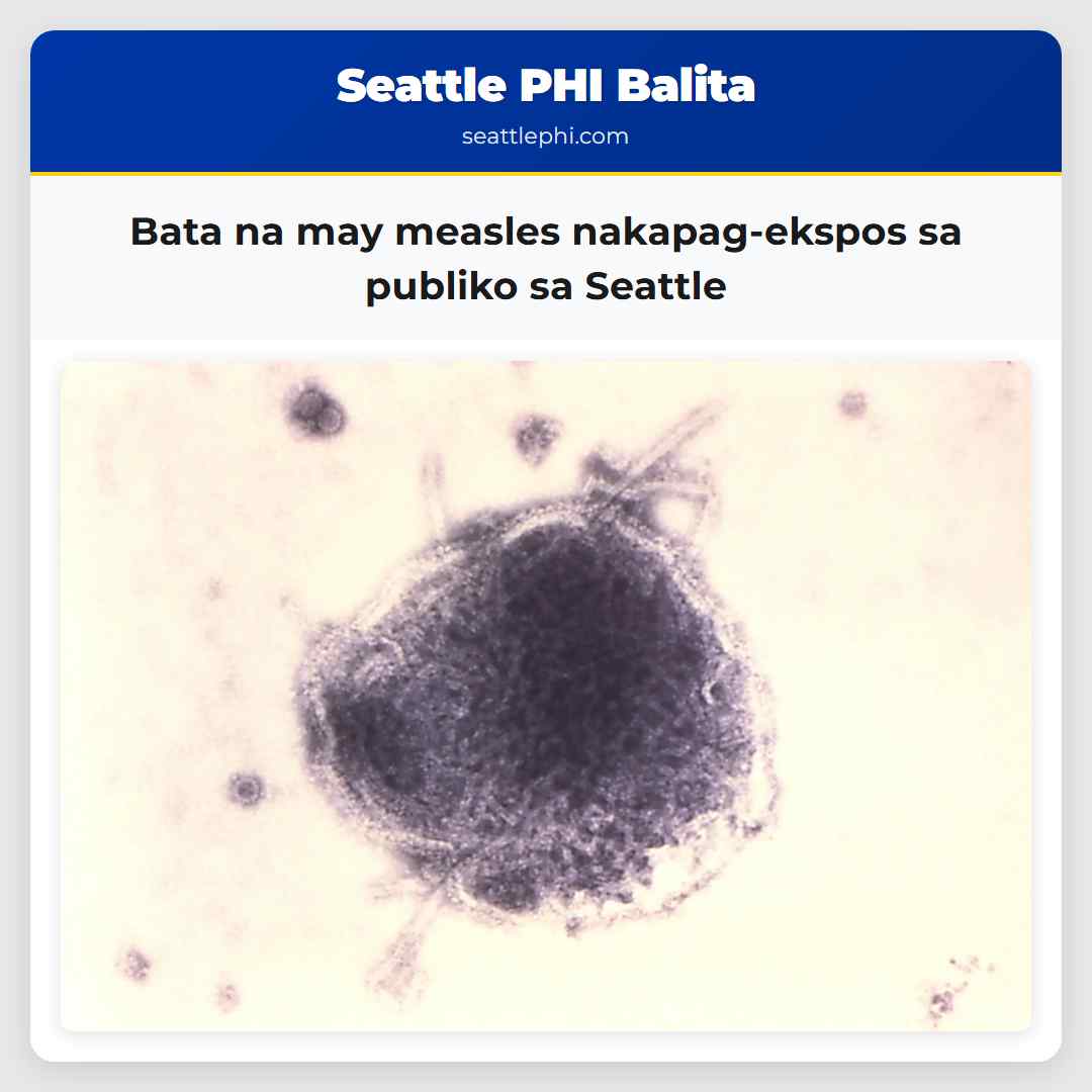 Bata na may measles nakapag-ekspos sa publiko sa